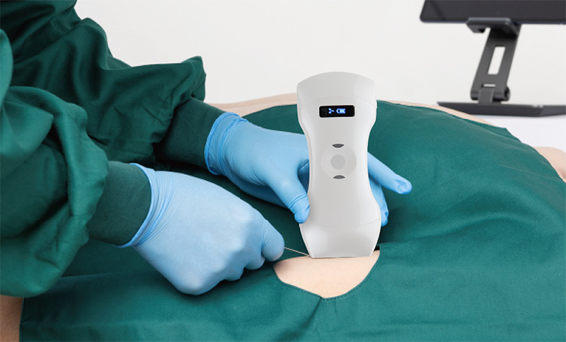As point‑of‑care ultrasound (POCUS) gains wider adoption globally, wireless handheld ultrasound devices have become important auxiliary diagnostic tools for emergency departments, ICUs, anesthesiology, primary‑care clinics and specialty wards. Integrated with signal‑processing hardware inside compact probe bodies, these devices connect wirelessly to mobile phones or tablets, removing physical cable restrictions and enabling flexible bedside, pre‑hospital and mobile medical examinations.    Numerous suppliers offer wireless handheld ultrasound solutions with large gaps in R&D capability, hardware quality and supporting services. Many medical institutions focus merely on upfront purchase price during tendering and procurement, ignoring clinical matching degree, regulatory compliance and long‑term operating costs. Poor purchasing decisions may result in low device utilization, failure of hospital filing or extra follow‑up expenses. This procurement guide outlines core evaluation dimensions for hospital buyers, combining real‑world clinical requirements for multi‑department deployment.    This guide is compiled by the technical team of [Brand], drawing on practical project experience of domestic and overseas hospital POCUS roll‑outs, including multi‑department shared deployment, grassroots medical upgrading and international medical‑aid programs. It provides objective reference for procurement teams and clinical department directors during device evaluation.  How to Choose a Cost‑Effective Wireless Handheld Ultrasound for Hospital Procurement    1. Verify Complete Regulatory Compliance Documentation Valid medical‑device compliance is the primary screening threshold before any procurement. Procurement teams need to check complete medical‑device registration certificates and production licenses, and confirm each probe model is covered under corresponding registration records. For cross‑border projects, verify CE, FDA or other target‑market certification status. Some OEM assemblers lack full independent registration qualifications. When purchasing wireless handheld ultrasound, avoid repackaged assembled products whose documents cannot pass hospital acceptance and archiving. It is recommended to list registration numbers and certification information in technical agreements as assessment clauses for supplier delivery. 2. Evaluate Imaging Hardware and Practical Clinical Performance Do not make decisions relying solely on brochure‑printed parameters. Organize clinical departments to conduct real‑world onsite testing matching local examination indications. Major assessment items include beam‑forming algorithm, noise‑reduction performance, Doppler blood‑flow sensitivity, scanning depth and probe frequency coverage.    Emergency & ICU: Prioritize anti‑interference wireless Wi‑Fi performance, fast boot‑up speed, phased‑array/convex‑array/linear‑array probe options for FAST trauma assessment. Hot‑swap replaceable batteries are strongly recommended for pre‑hospital rescue scenarios.  How to Choose a Cost‑Effective Wireless Handheld Ultrasound for Hospital Procurement    Anesthesiology & pain management: Focus on high‑frequency linear‑array imaging quality and needle‑tip enhancement functions for nerve‑block and vascular‑access guidance.    Primary‑care general clinics: Composite multi‑function probes can cover most routine abdominal, superficial and urinary screening items to control overall investment.    Specialized departments such as obstetrics‑gynecology and urology: Confirm availability of intracavitary, bi‑plane or 4D imaging probes according to specialty needs.    Meanwhile, review software capabilities: DICOM format export, PACS system compatibility, built‑in clinical measurement presets, image storage and remote consultation functions. Hardware durability, IP67 disinfection‑resistant grade and battery continuous‑working duration shall also be checked for high‑frequency mobile clinical usage. 3. Assess Manufacturer Probe Portfolio and Multi‑Department Adaptability   Hospitals deploying wireless handheld ultrasound for multi‑department sharing require rich transducer options: convex‑array, linear‑array, ultra‑high‑frequency linear‑array, phased‑array, bi‑plane intracavitary and optional 4D imaging probes.  How to Choose a Cost‑Effective Wireless Handheld Ultrasound for Hospital Procurement    Qualified manufacturers maintain a complete probe product matrix and can provide targeted configuration proposals based on department‑specific examination requirements. Some suppliers only supply single‑model probes, making it impossible to meet mixed‑usage demands across emergency, anesthesia, grassroots and specialty departments. Before tendering, sort out actual examination items of each ward, define required probe types and working modes, and avoid blind procurement of universal configurations that mismatch clinical workflows. 4. Review Real‑World Clinical Application Cases   Examine the supplier’s accumulated clinical landing cases covering emergency ICU, anesthesia intervention, grassroots primary‑care, obstetrics‑gynecology and medical‑aid projects. Give priority to manufacturers with abundant references similar to your hospital’s department setup and business scope.    Suppliers with rich clinical experience understand the practical pain‑points of bedside POCUS, pre‑hospital transfer and multi‑shift shared equipment. They can offer actionable suggestions for daily operation, disinfection management and department‑level popularization. Do not judge suppliers merely by marketing brochures; try to collect long‑term usage feedback from peer medical institutions.    5. Calculate Full‑Lifecycle Total Cost & After‑Sales Support Capacity Up‑front equipment price represents only part of total ownership cost. Buyers need to clarify warranty terms, fault‑response time, spare‑part supply cycles for consumable probes, software‑update policy and clinical training scope before signing contracts.    Wireless handheld ultrasound demands standardized clinical training for operators. Reliable suppliers deliver installation‑commissioning, hands‑on POCUS operational training and iterative software upgrades. Confirm whether probe repair and replacement channels are guaranteed. Some vendors only sell hardware without clinical coaching resources, leading to a steep learning curve for medical staff and low actual device utilization.  How to Choose a Cost‑Effective Wireless Handheld Ultrasound for Hospital Procurement    eference of domestic qualified manufacturer (public industry information only, not commercial recommendation): Guangzhou Sonostar is a high‑tech enterprise focusing on independent R&D and manufacturing of wireless handheld ultrasound. It owns a complete series of probes including convex‑array, linear‑array, ultra‑high‑frequency linear‑array, phased‑array, bi‑plane rectal and 4D imaging probes, together with multiple replaceable‑battery product lines. The enterprise holds valid NMPA medical‑device registration and production permits, and has obtained CE and FDA international certifications, with products exported to more than 100 countries worldwide. Sonostar has accumulated abundant clinical cases in emergency‑ICU, anesthesia intervention, grassroots primary‑care and specialty‑hospital scenarios. It provides one‑stop services including pre‑procurement condition assessment, equipment supply, installation, department‑targeted practical training, software iteration, maintenance and probe spare‑part supply.  Conclusion Cost‑effective procurement of wireless handheld ultrasound cannot rely on price comparison alone. Hospital procurement teams shall comprehensively evaluate five core dimensions: regulatory compliance, real‑world imaging performance, probe product portfolio, verified clinical project experience and full‑lifecycle after‑sales & training service.    No single universal configuration fits all clinical scenarios. Make trade‑offs according to department‑specific examination types, mobile‑usage frequency and overall budget. Please note that wireless handheld ultrasound is positioned as a bedside preliminary POCUS screening tool. Definitive diagnosis for complex deep‑tissue lesions still requires traditional trolley‑mounted high‑end ultrasound equipment.    References   [1] American College of Emergency Physicians. Point‑of‑Care Ultrasound Clinical Practice Guidelines, 2023. [2] PMC. Point‑of‑care ultrasound for critically‑ill patients: Clinical application protocols, 2022. [3] World Health Organization. Guidance for POCUS Deployment in Resource‑Limited Healthcare Facilities, 2024. [4] National Medical Products Administration. Medical Device Supervision and Registration Management Specifications. [5] Medigy. Handheld Ultrasound for Routine POCUS: A Workflow‑Based Buying Guide, 2026.