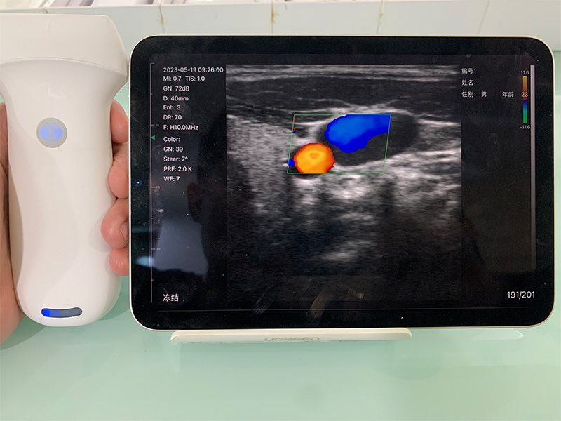 Can Wireless Probe‑Based Handheld Ultrasound Meet the Needs of Routine Community‑Based Preliminary S