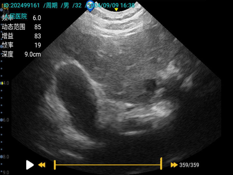 Why Emergency Centers and Community Hospitals Equip Wireless Portable Palm Ultrasound Why Emergency Centers and Community Hospitals Equip Wireless Portable Palm Ultrasound